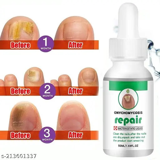 Nail Serum for Nail Growth & Repair 30ML (Pack of 1) - Springkart