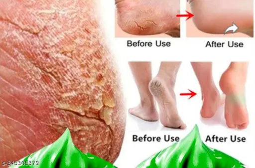 Crack Blaster Repair - Cracked Skin, Heel, Finger Healing Balm Cream (100gm) - Springkart