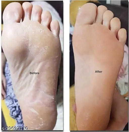 Foot Crack Cream For Dry Cracked Heels & Feet (50gm) - Springkart