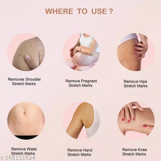 Top branded Repair Stretch Marks Removal - Springkart