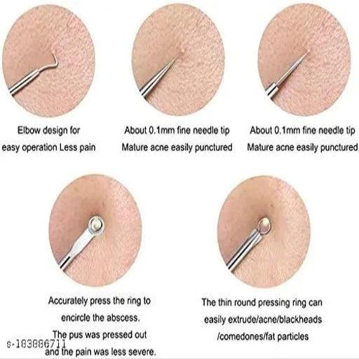 Stainless Steel Blackhead Pimple Blemish Extractor/Remover Tool - Springkart