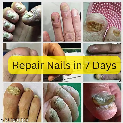 Nail Serum for Nail Growth & Repair 30ML (Pack of 1) - Springkart