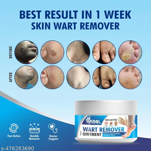 Warts Remover Ointment | wart remover lotion 50gm