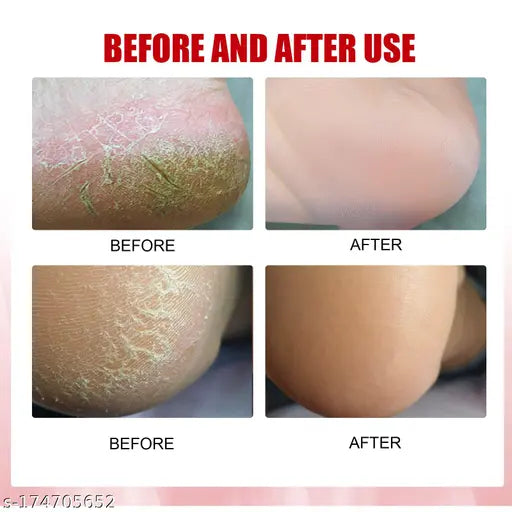 Best Crack Cream For Dry Cracked Heels & Feet. - Springkart