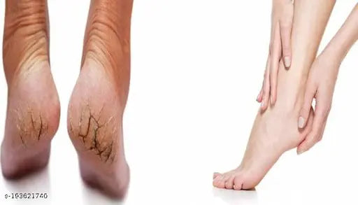 Soft soles Intensive Foot Care Cream & Moisturise Skin (30g Each) Pack of 2 - Springkart