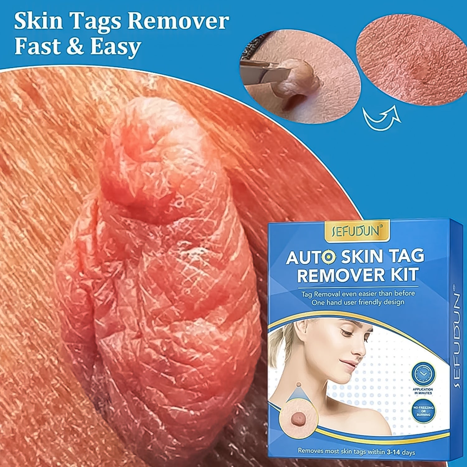 Skin Tag Remover Kit 2 in 1 for Micro to Large (2 mm - 8 mm / 1 Set) - Springkart 