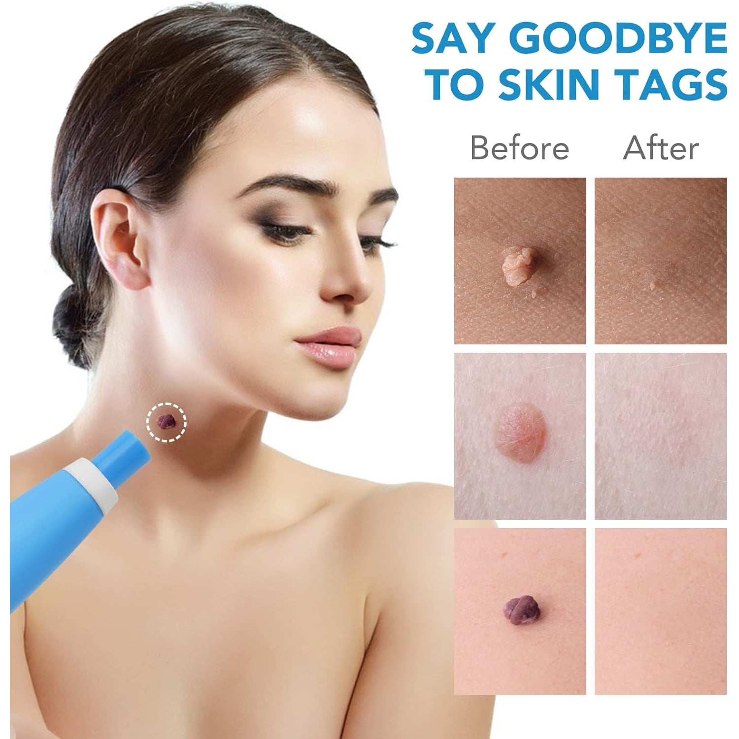 Skin Tag Remover Kit 2 in 1 for Micro to Large (2 mm - 8 mm / 1 Set) - Springkart 
