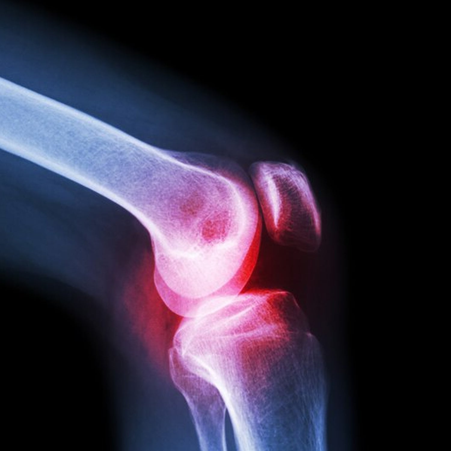 Knee Cap for Knee Support (Large) - Springkart 