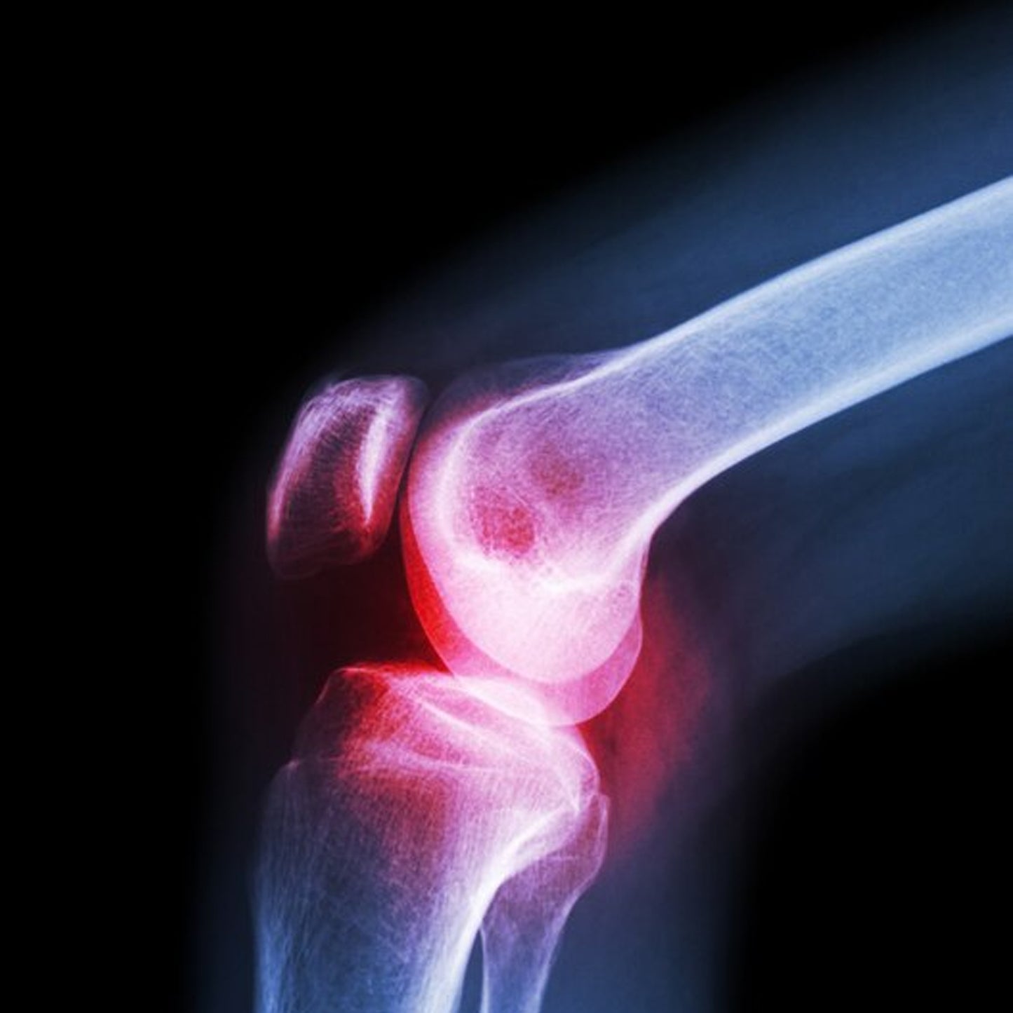 6233 (Xl) Knee Cap For Knee Support - Springkart 