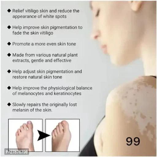 Vitiligo treatment cream/ Vitiligo relief spray/ Skin treatment lamp /White Spot Removal/ vitiligo Treatment 90 days 10ml (set of 2) Payment:- Pre-Paid