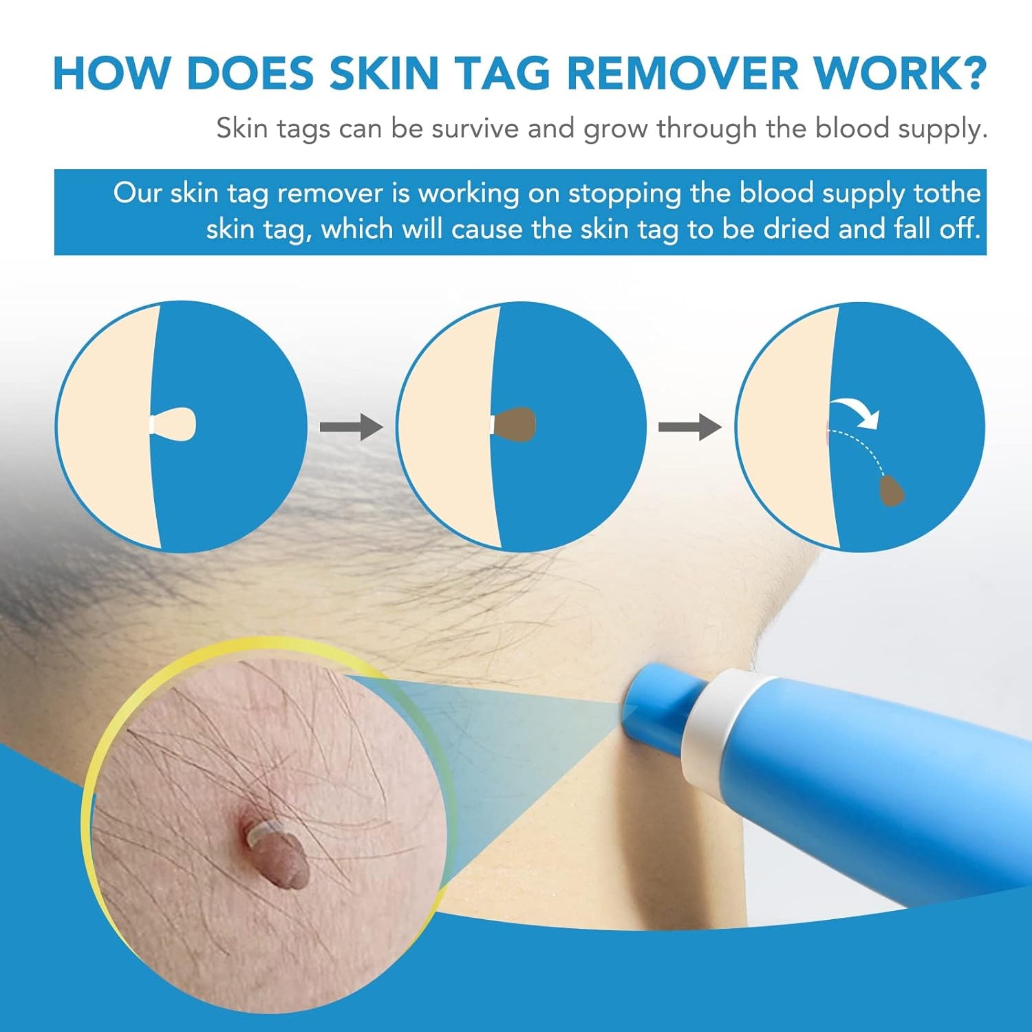 Skin Tag Remover Kit 2 In 1 For Micro To Large (2 Mm - 8 Mm 1 Set) - Springkart 