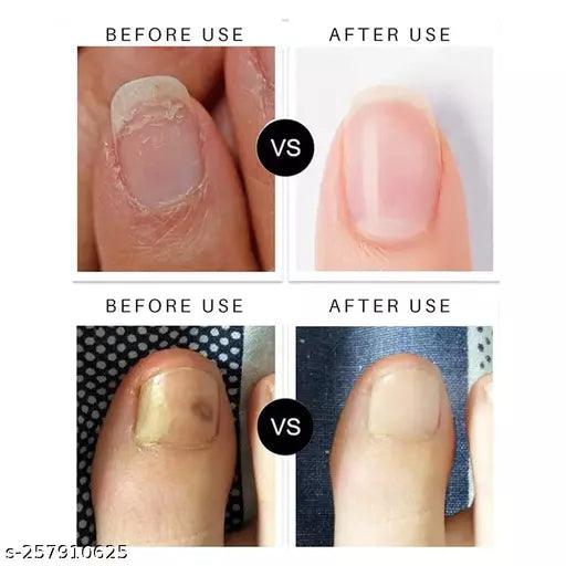 Premium Nail & Cuticle Growth Oil- For Nail Growth, Repair & Cuticle Care 30ML - Springkart 