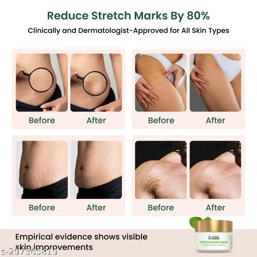 Stretch Marks Cream - Advanced Stretch Mark Removal Cream