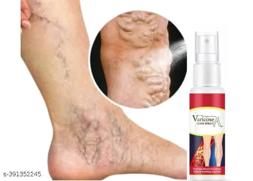 Varicose Veins Spray - 30 ML, Instant Leg Relief For Leg - Pack of 3. - Springkart 