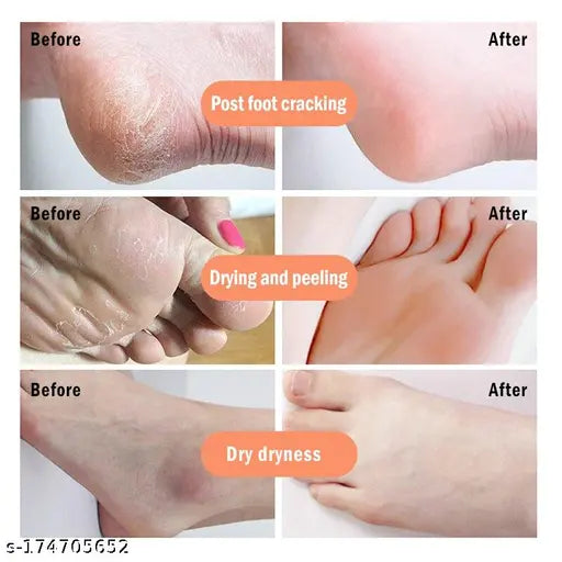 Best Crack Cream For Dry Cracked Heels & Feet. - Springkart 